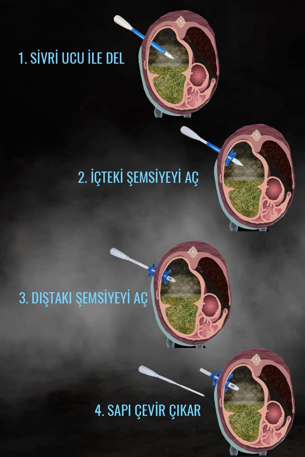 ŞEMSİYE TROKAR RUMENOTOM
